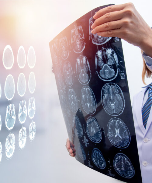 woman doctor holding MRI film to diagnosis injury area of brain with double exposure of brain CT scan