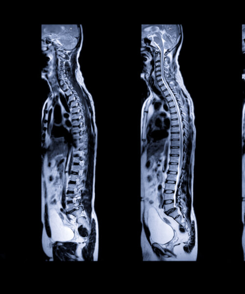 Collection of MRI of whole spine T2W sagittal plane for diagnostic Spinal Cord Compression.