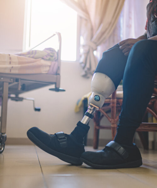 An Asian Indian person with prosthetic leg adjusting her artificial limb at hospital ward