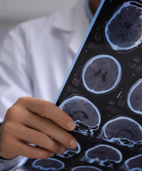 Doctor examining MRI images of patient with multiple sclerosis in clinic, closeup