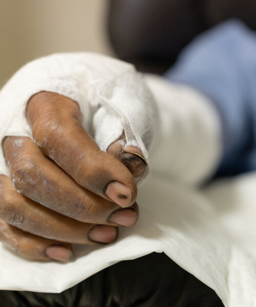 Patient with burns in the hospital. applying bandage onto patient's arm burn wound.