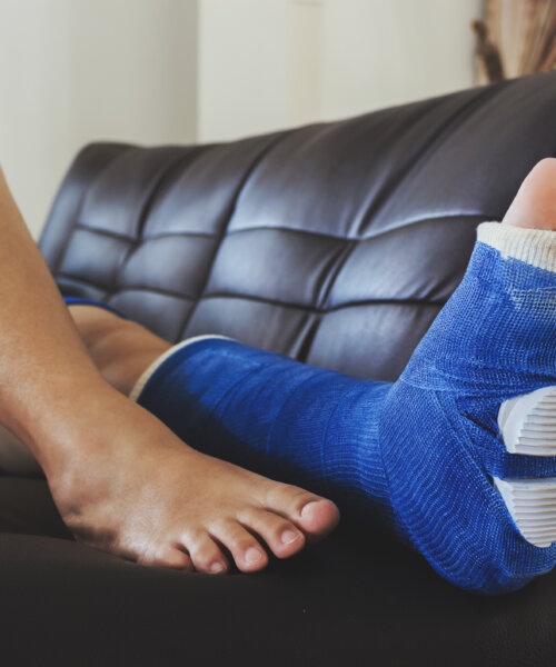 broken leg in a plaster cast