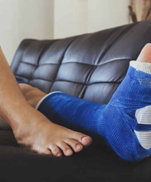 broken leg in a plaster cast